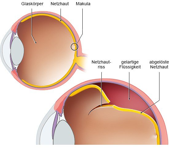 Grafik: links: gesundes Auge, rechts: Auge mit rissbedingter Netzhautablösung 