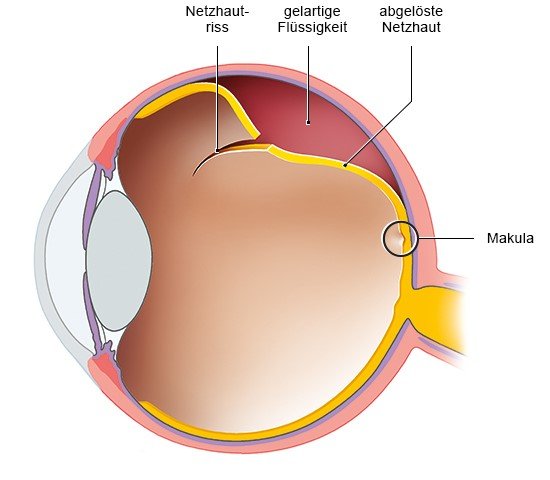 Grafik: Auge mit rissbedingter Netzhautablösung 