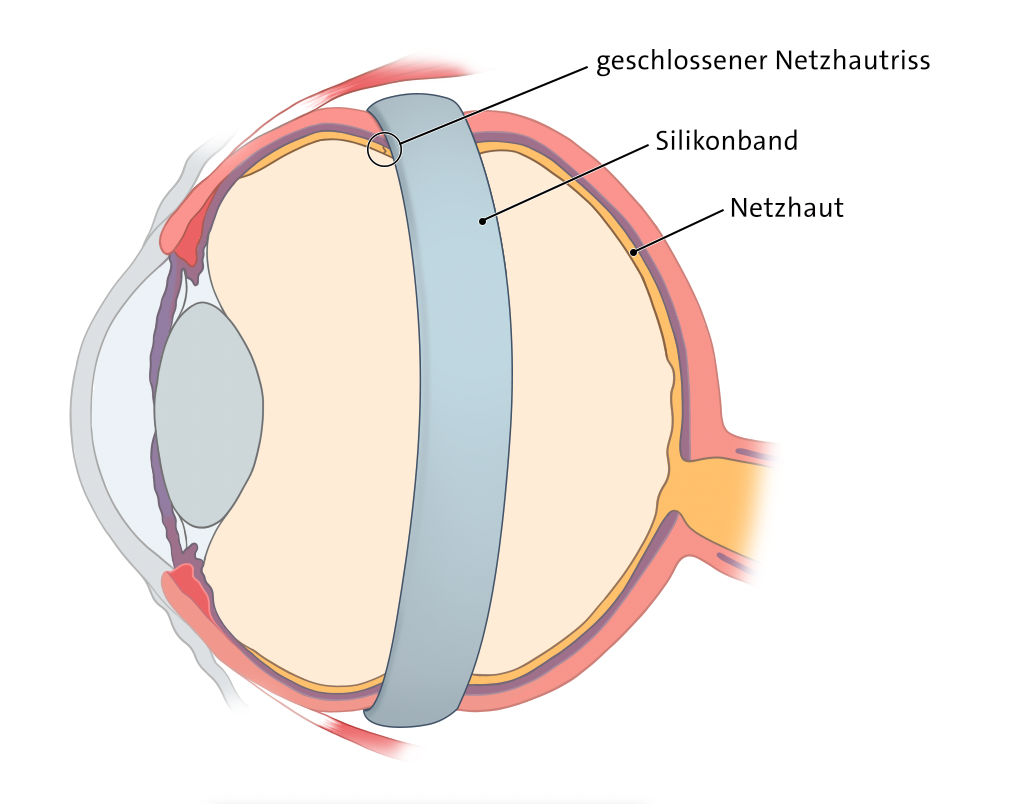 Grafik: Eindellende Operationsverfahren: Silikonband 