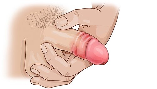Grafik: Eichelentzündung bei einem erwachsenen Mann mit zurückgestreifter Vorhaut
