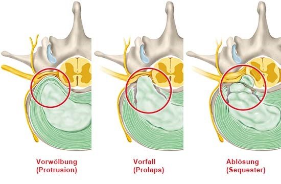 Grafik: Arten von Bandscheibenvorfällen: Vorwölbung, Vorfall und Ablösung (Querschnitt durch die Lendenwirbelsäule – Ansicht von oben)