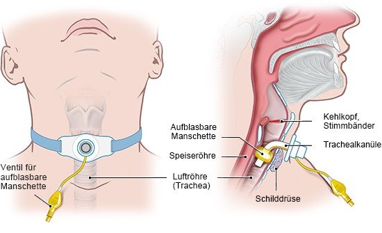 Grafik: Darstellung Tracheostoma, ein künstlicher Zugang zur Luftröhre