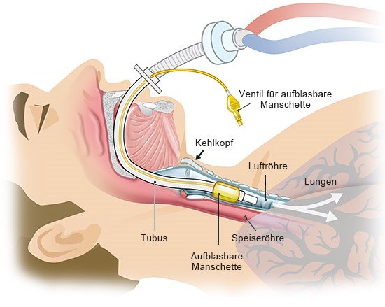 Grafik: Bei der Intubation wird über einen Schlauch Luft direkt in die Luftröhre geleitet