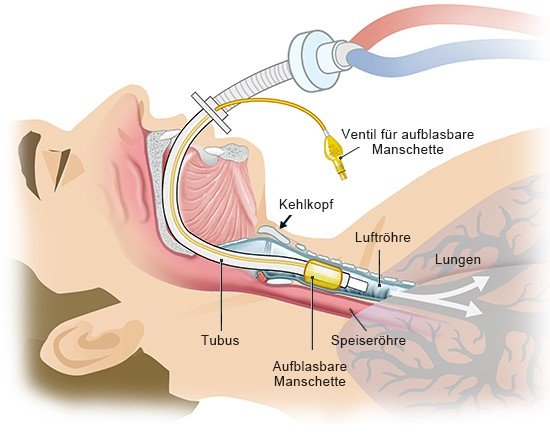 Grafik: Über den Schlauch (Tubus) wird die Luft direkt in die Luftröhre geleitet