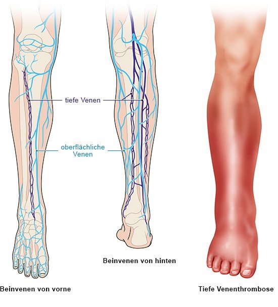 Grafik: Gesundes Bein und Unterschenkel mit tiefer Venenthrombose