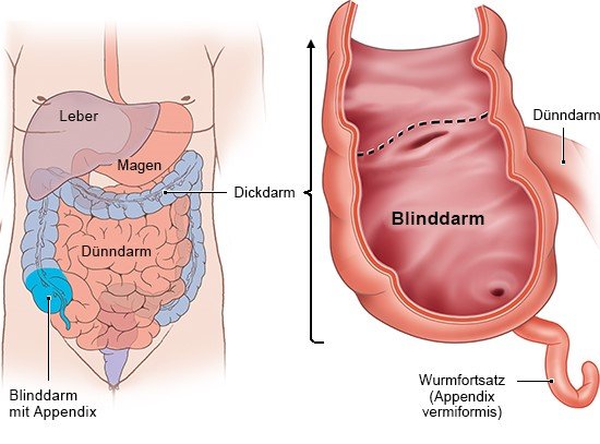 Grafik: Der Wurmfortsatz hängt am Blinddarmende