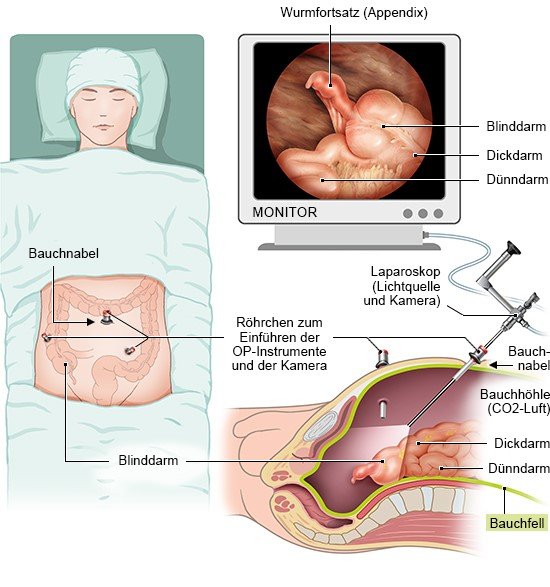 Grafik: Laparoskopische Entfernung des Wurmfortsatzes