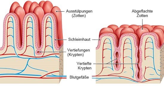 Grafik: links gesunde Darmschleimhaut, rechts geschädigte Darmschleimhaut