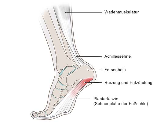 Fuß mit Plantarfasziitis 