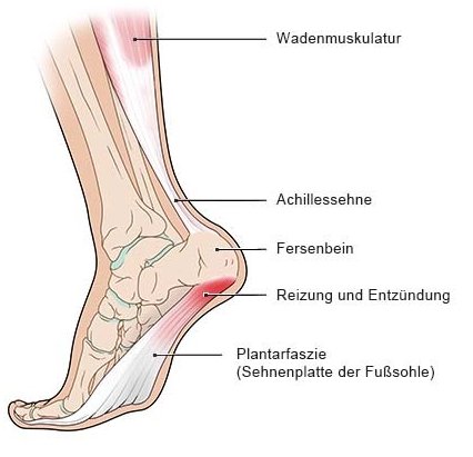 Fuß mit Plantarfasziitis 