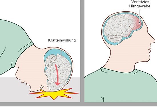 Grafik: Gehirnerschütterung: Krafteinwirkung bei einem Aufprall mit dem Kopf