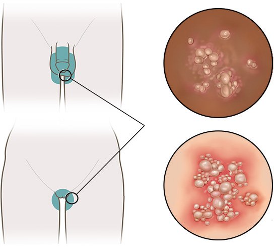 Grafik: Wo Genitalherpes auftritt und wie er aussieht