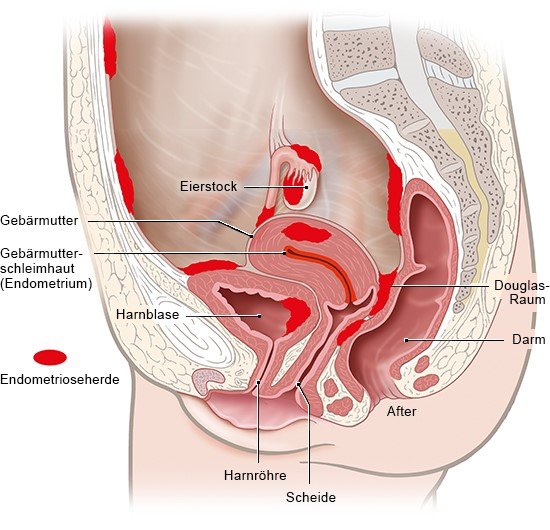 Gebärmutterentfernung geschlechtsverkehr nach Entfernung der