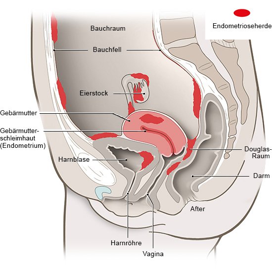 Grafik: Unterleib mit Endometriose-Herden, wie im Text beschrieben