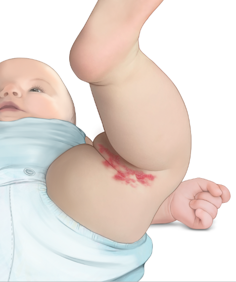 Grafik: Säugling mit Hämangiom am Unterschenkel