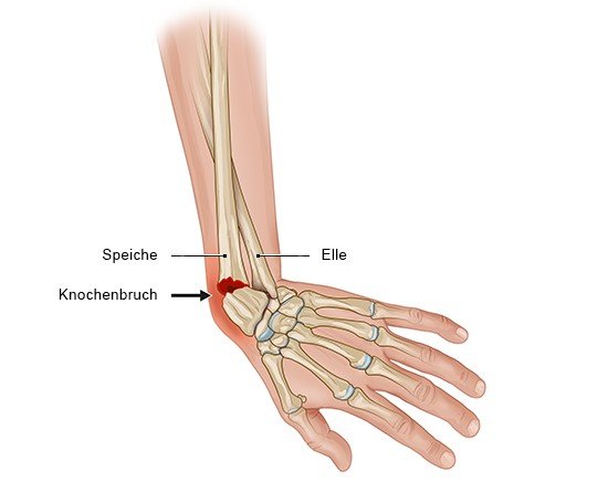 Brechen den kann arm ohne schmerzen man sich wie Rücken: Wenn