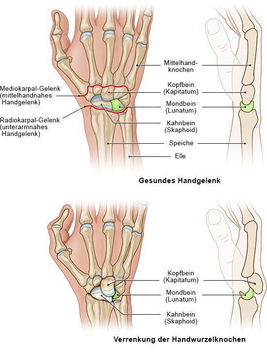 Grafik: Gesundes Handgelenk und Verrenkung der Handwurzelknochen