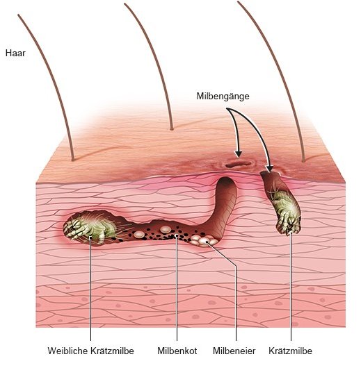 Grafik: Krätzmilben unter der Haut mit Gangsystem