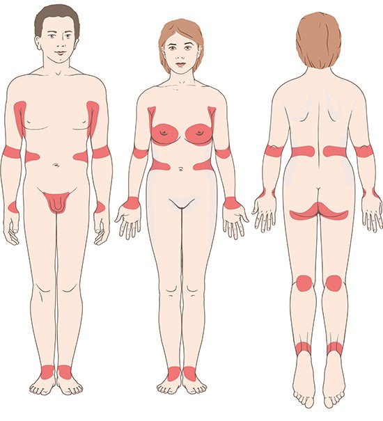 Breitet sich die Krätzmilbe aus? - Ansteckung, Behandlung & Symptome