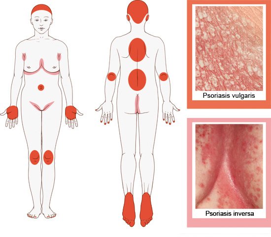 Grafik: Von Psoriasis vulgaris oder inversa betroffene Hautstellen - wie im Text beschrieben