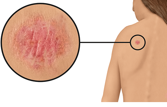 Grafik: Wie weißer Hautkrebs auf heller Haut an der Schulter aussehen kann