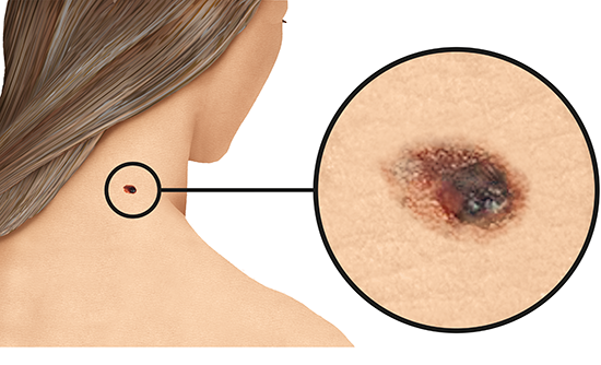 Grafik: Schwarzer Hautkrebs am Hals auf heller Haut