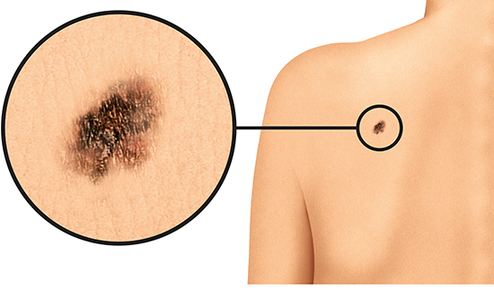 Grafik: Schwarzer Hautkrebs auf dem Schulterblatt bei heller Haut