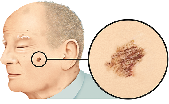 Grafik: Schwarzer Hautkrebs auf der Wange bei heller Haut