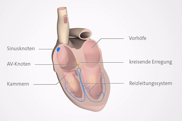 Grafik: Wenn im AV-Knoten die Erregung kreist, schlägt das Herz zu schnell