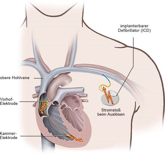 Grafik: Ein ICD-Gerät gibt einen oder mehrere Stromstöße zur Normalisierung des Herzrhythmus ab
