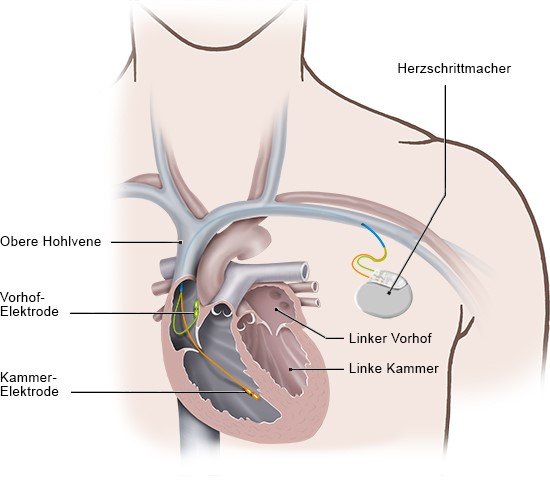 Grafik: Herzschrittmacher mit Elektroden im rechten Herzen