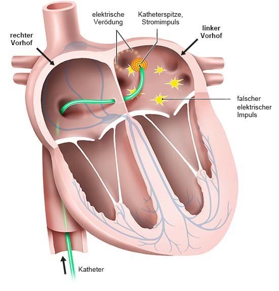 Grafik: Per Katheter werden Stellen verödet, die Herzrhythmusstörungen auslösen.