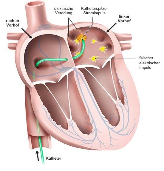 Grafik: Per Katheter werden Stellen im linken Vorhof verödet.