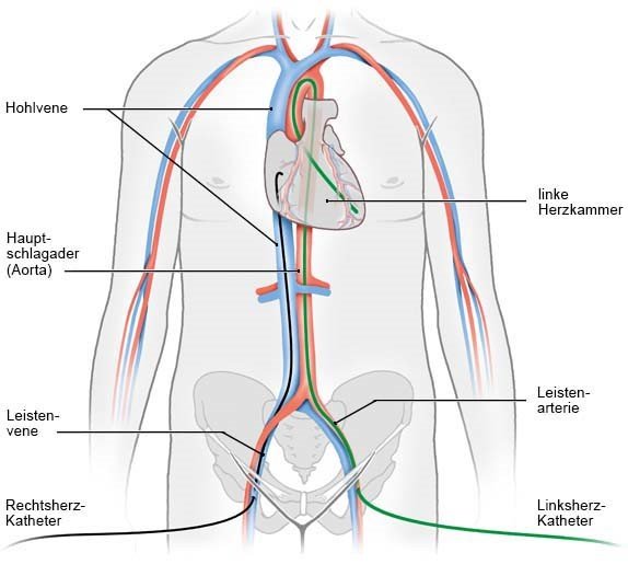 Grafik: Linksherz- und Rechtsherz-Katheter, jeweiliger Zugang und Katheterdarstellung bis zum Herzen