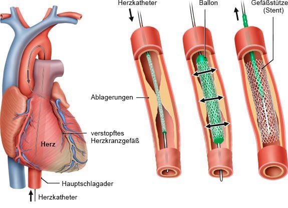 Grafik: Herzkatheter mit Ballon und Stent