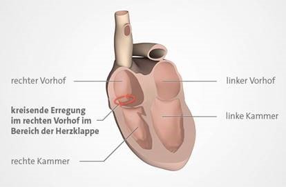Grafik: Typisches Vorhofflattern entsteht im rechten Vorhof. 