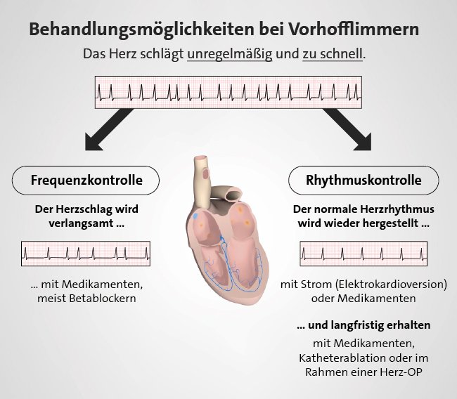 Grafik: Möglichkeiten, den Herzrhythmus bei Vorhofflimmern zu beeinflussen