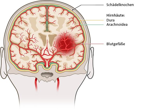 Die Grafik zeigt eine intrazerebrale Blutung mitten im Gehirn. Es blutet aus einer Hirnarterie direkt in das Gehirngewebe hinein.
