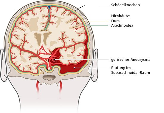 Die Grafik zeigt eine Subarachnoidal-Blutung, bei der Blut in den mit Flüssigkeit gefüllten Raum läuft, der das Gehirn umgibt.