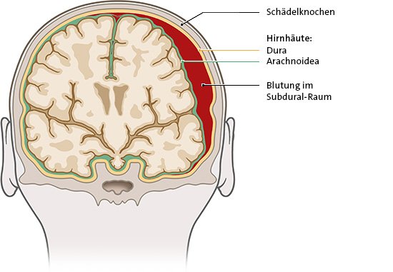 Die Grafik zeigt eine subdurale Blutung. Dabei blutet es in die feinen Spalten zwischen den Hirnhäuten und dem Schädelknochen.