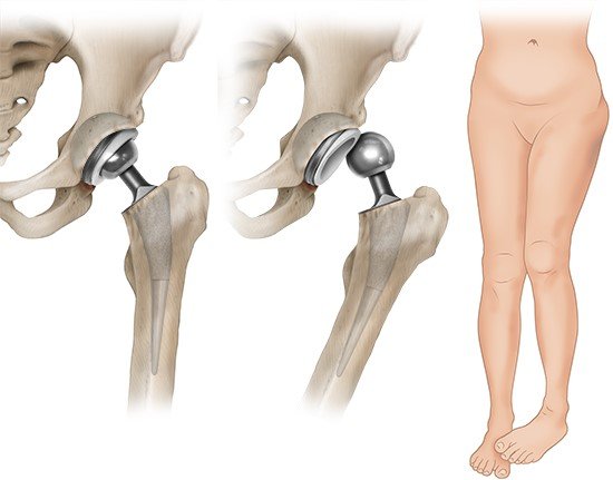 Links: Hüft-Prothese in normaler Position; Mitte: nach hinten ausgekugelte Hüft-Prothese; rechts: typisches Erscheinungsbild einer ausgekugelten Prothese