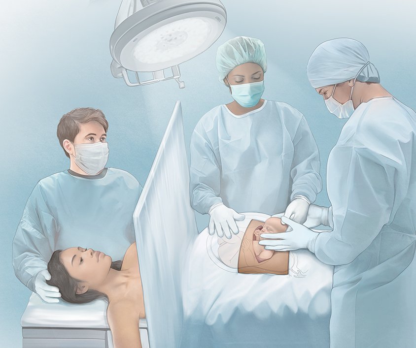 Grafik: Geburt des Kindes bei einer Kaiserschnitt-Operation