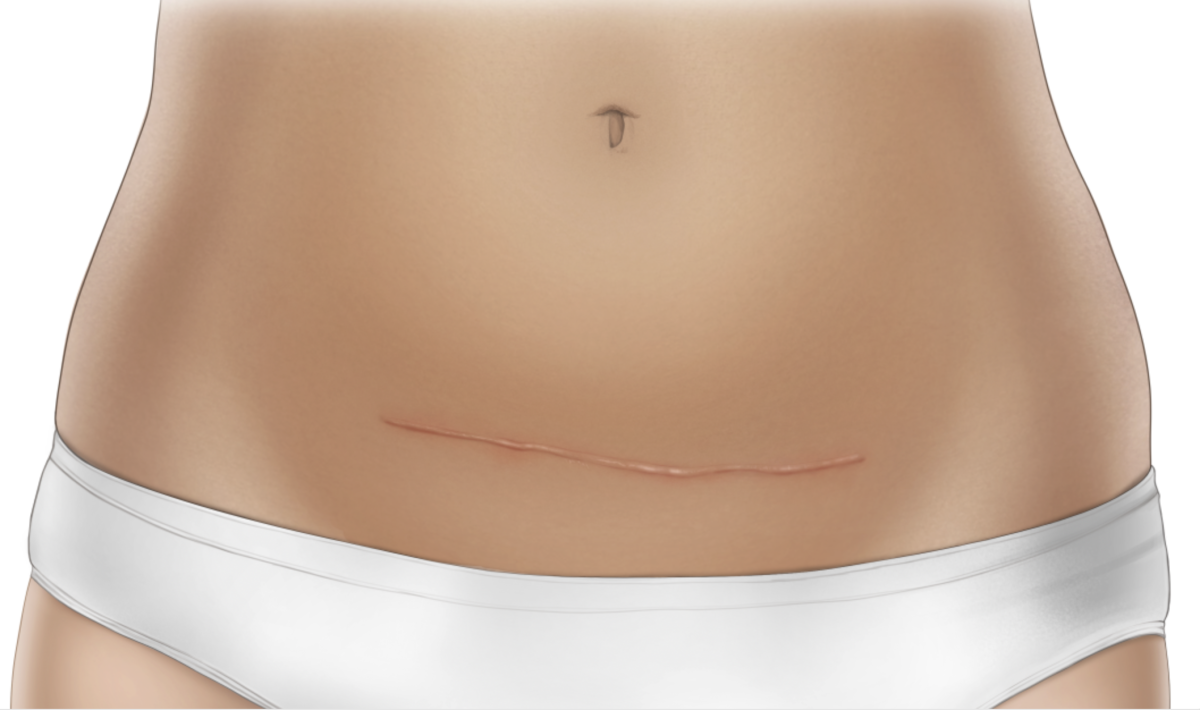 Grafik: Frische Narbe nach einer Kaiserschnitt-Operation