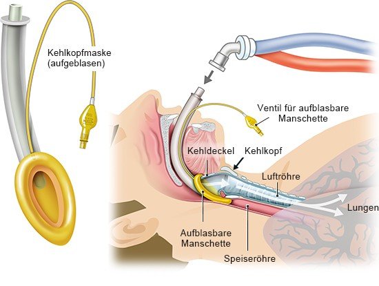 Grafik: Beatmung über Kehlkopfmaske