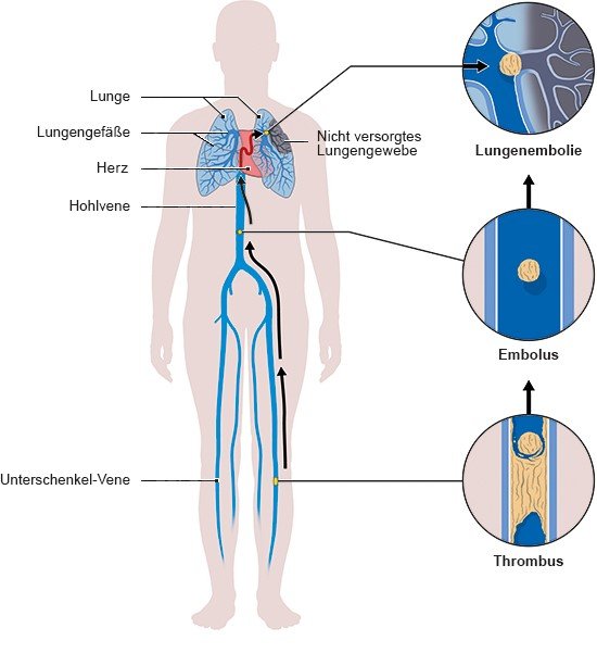 Entstehung einer Lungenembolie aus einer Thrombose