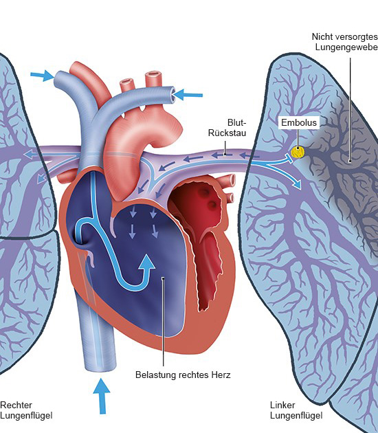 Belastung des Herzens durch eine Lungenembolie