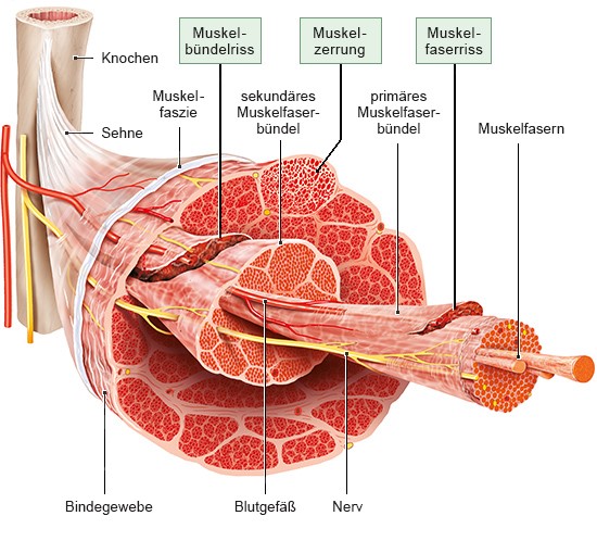 Grafik: Muskelzerrung, Muskelbündel- und -faserriss
