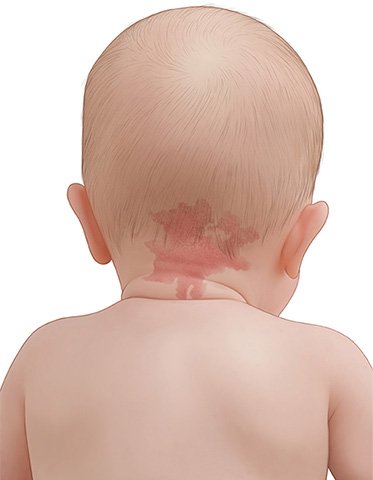 Grafik: Kind mit Nävus flammeus im Nacken (Storchenbiss)