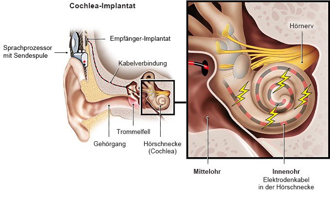 Grafik: Cochlea-Implantat