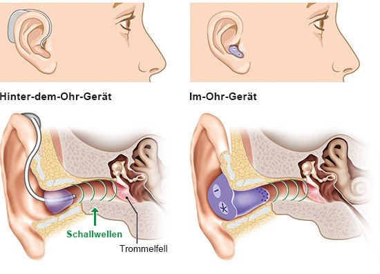 Grafik: Zwei verschiedene Hörgeräte